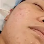 Acne Peel