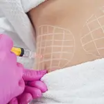 Body Lift