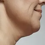Double Chin