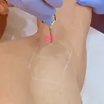 Full Body Laser Hair