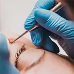 Milia Removal
