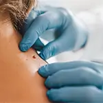 Mole Removal