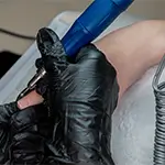 Tattoo Removal