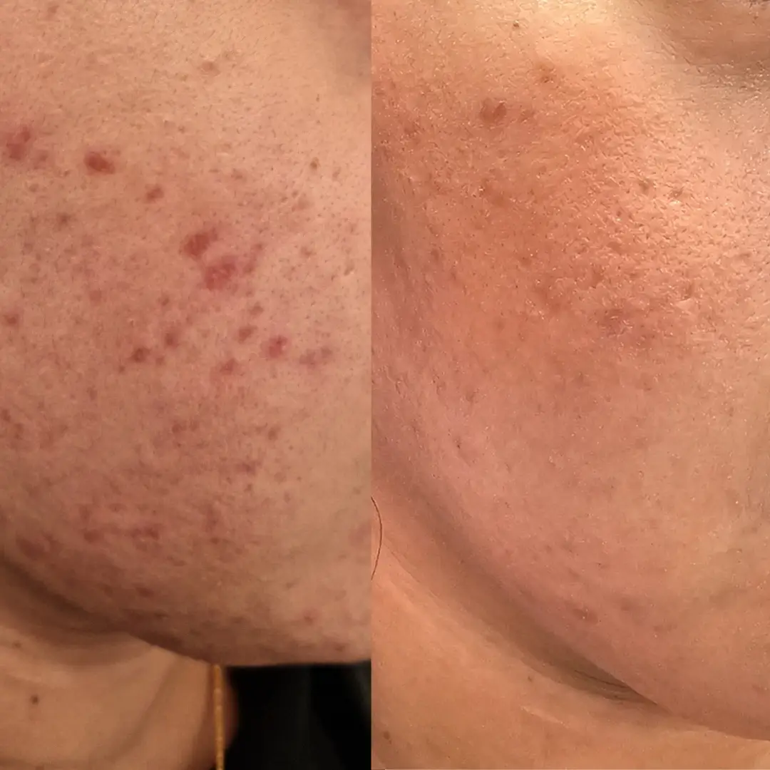 acne peel (1)