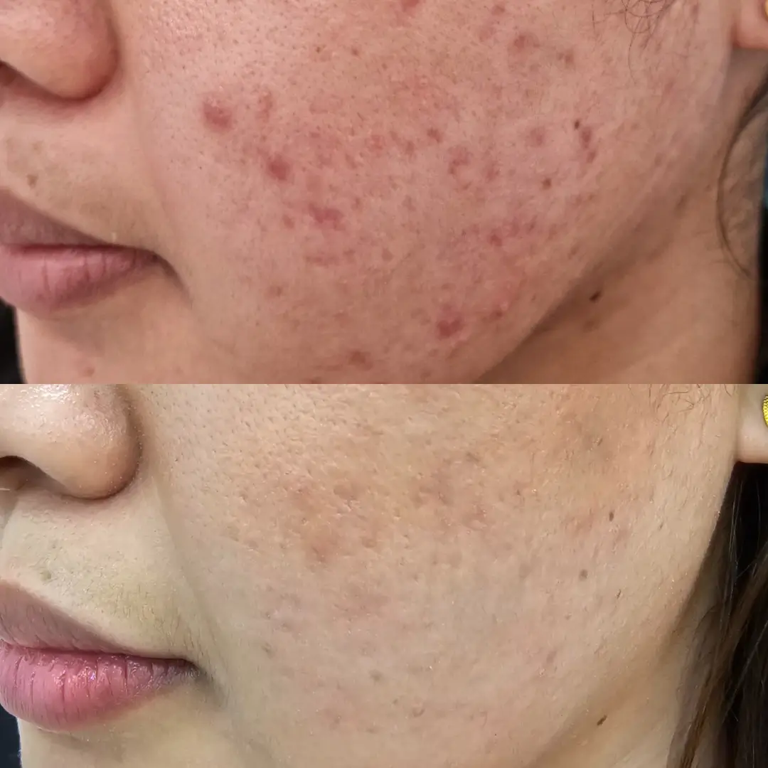 acne peel (2)