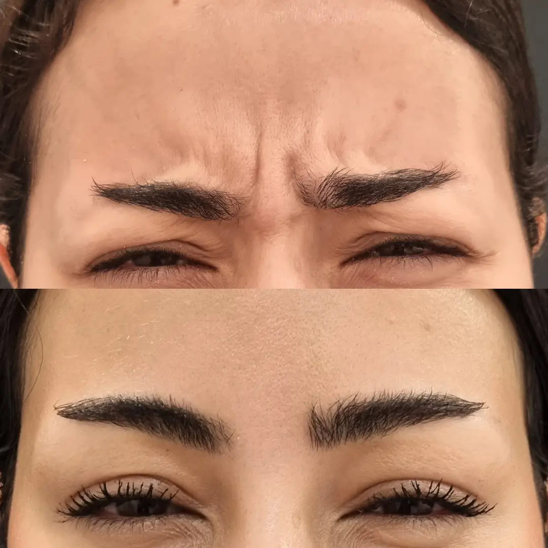 botox dr sara (2)