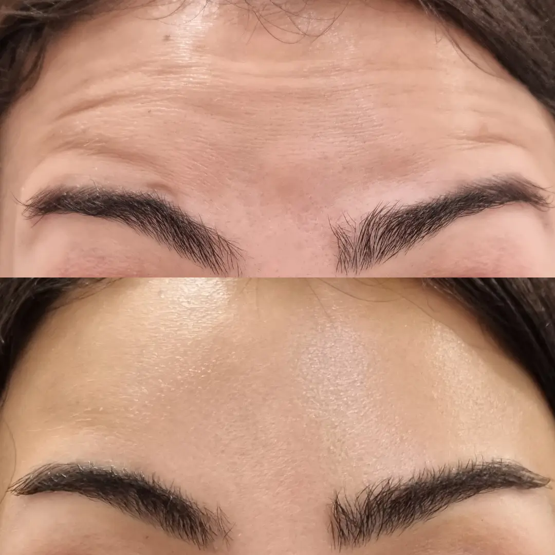 botox dr sara (3)