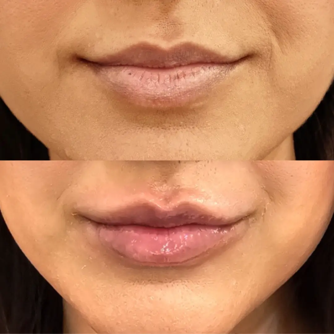 carbon laser lip