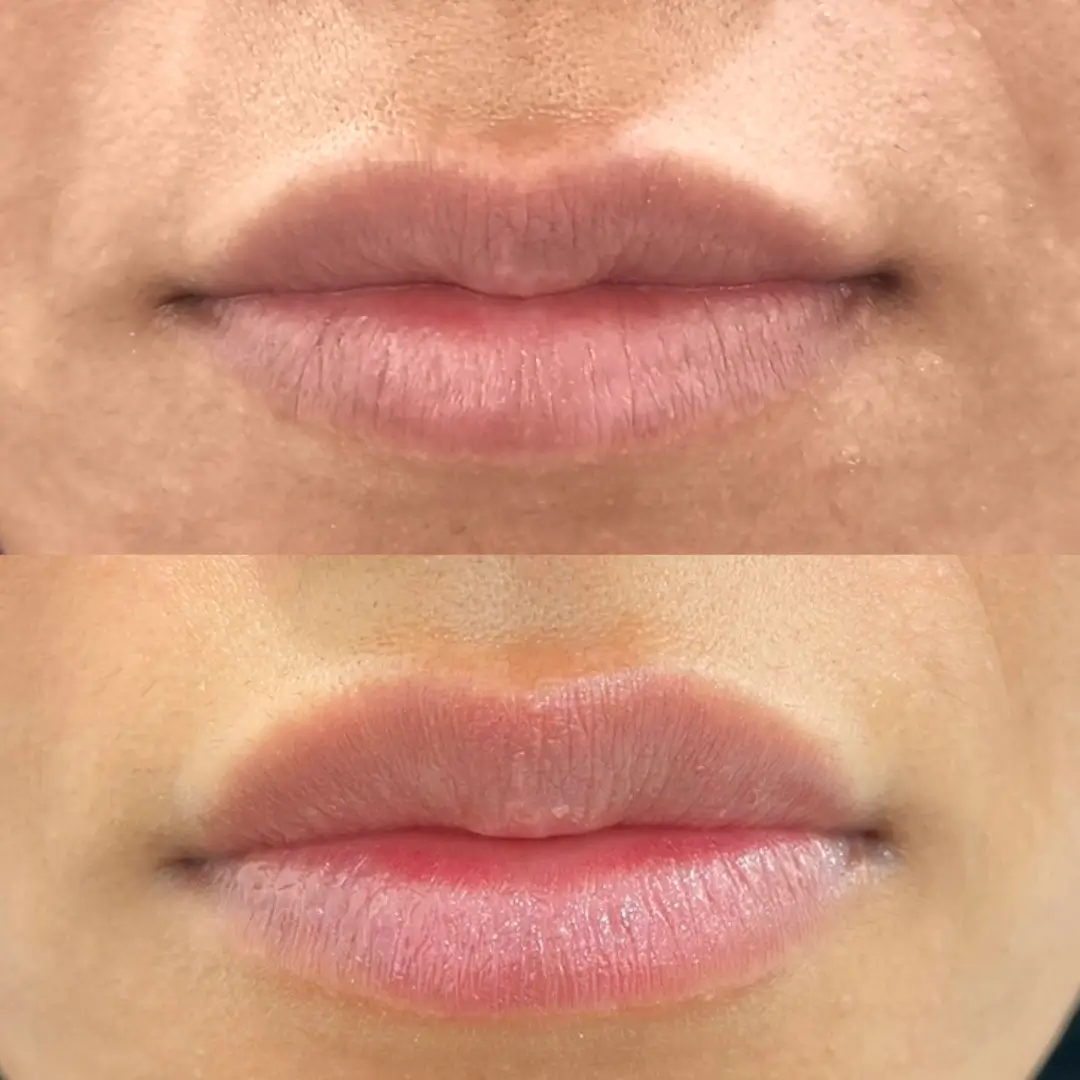 lip filler dr mahraa (1)