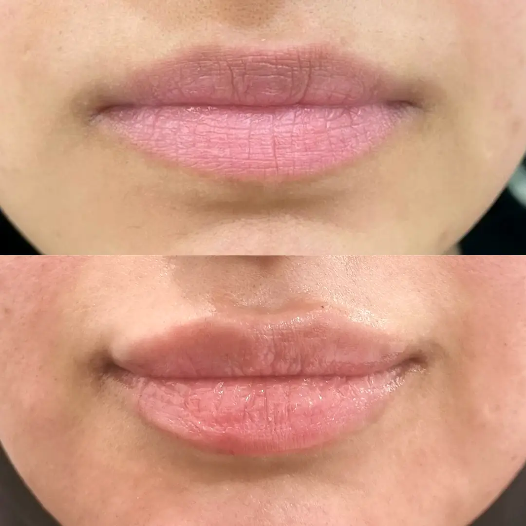 lip filler dr mahraa (2)