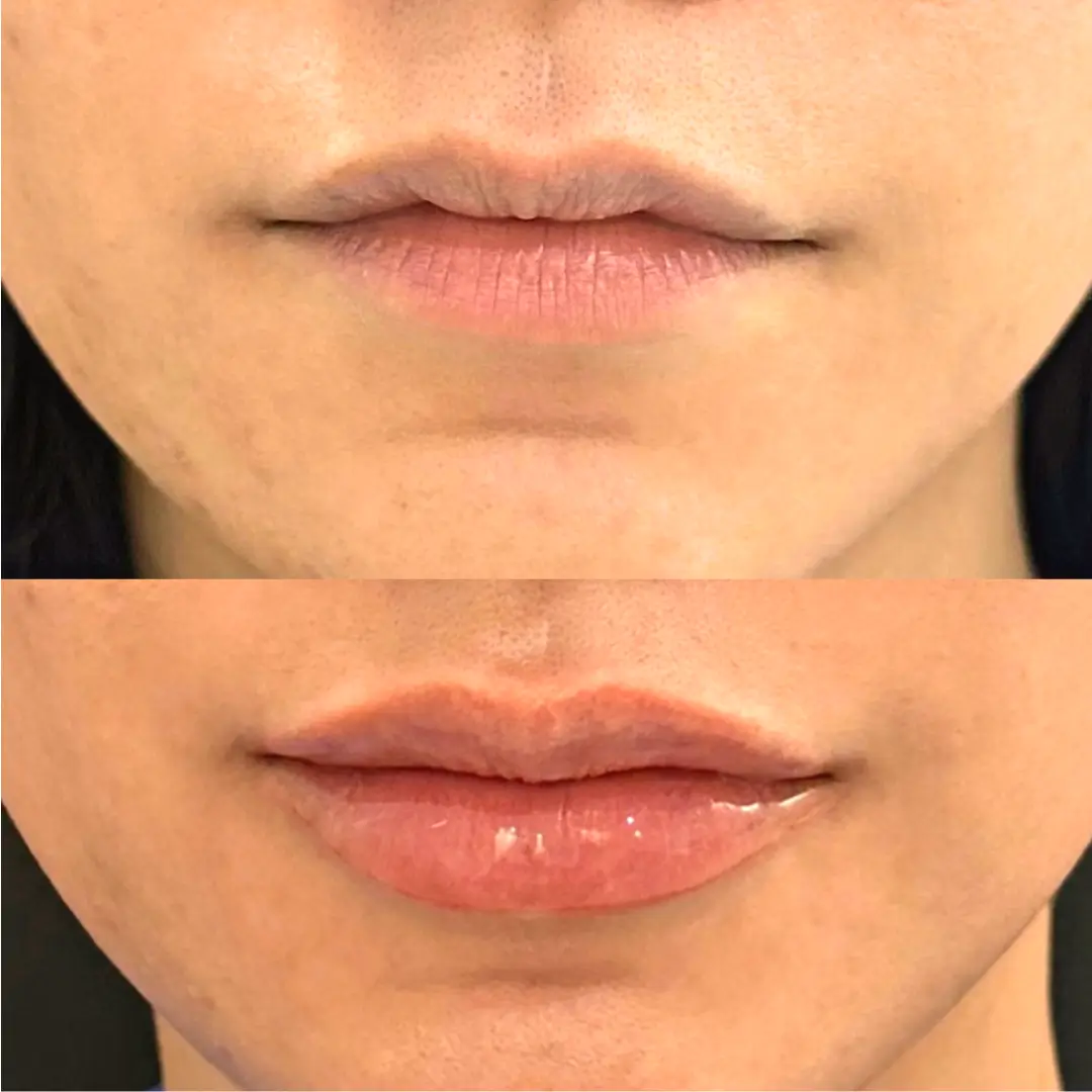 lip filler dr sara (1)