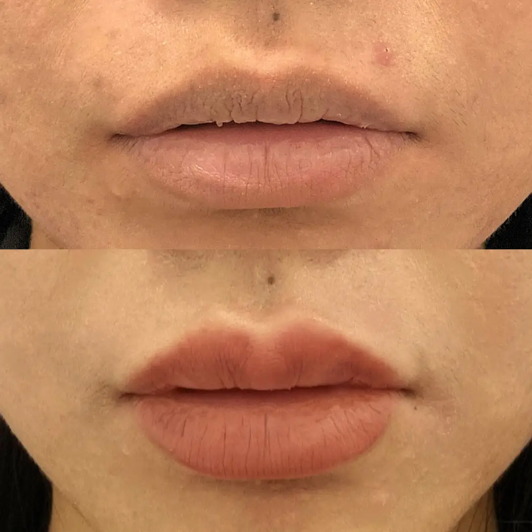 lip filler dr sara (3)
