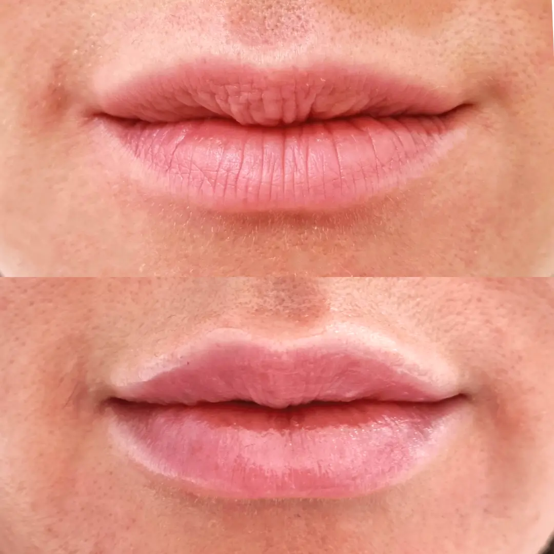 lip filler dr sara