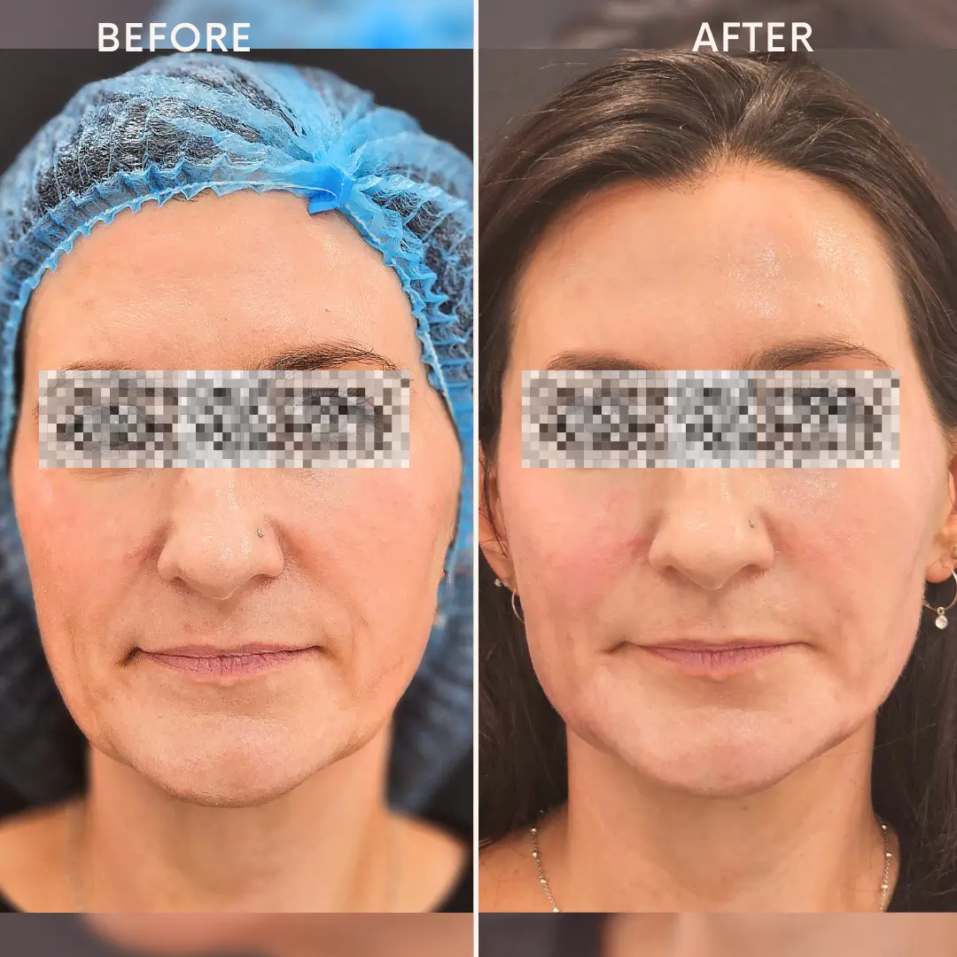 Face Enhancement2
