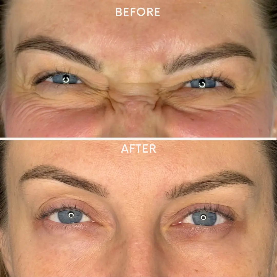 botox2