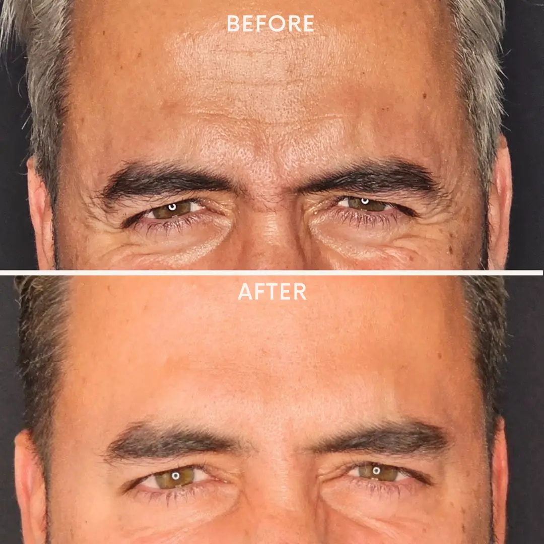 botox3