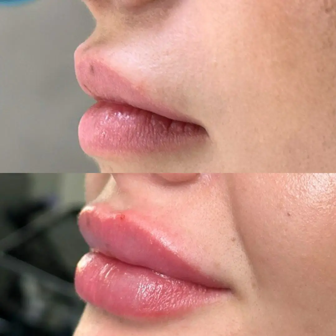 filler-results-2